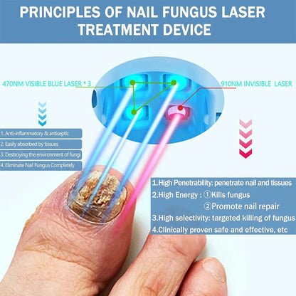 LuxeOrbit Rechargeable Fungus Grey Nail Treatment Device Portable Onychomycosis Treatment Laser Therapy Relieve Ingrown Foot Care