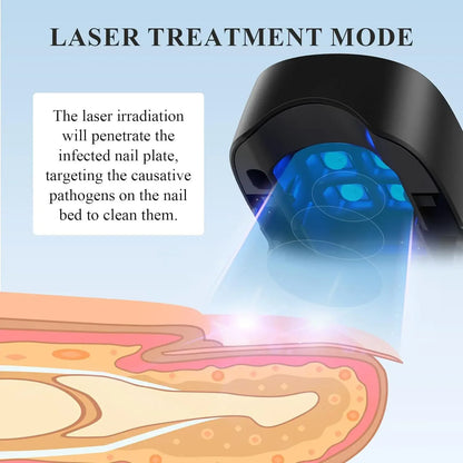 LuxeOrbit Nail Fungus Treatment Laser Device for Cleaning Onychomycosis USB Charge Anti Fungal Repair Damaged Discolored Thick Fingernails