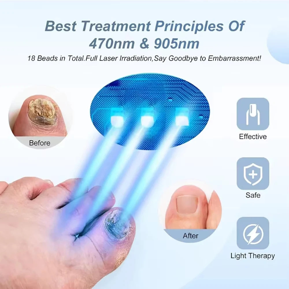 LuxeOrbit Fungal Nail Laser Device Repair Fast Nails Fungus Onychomycosis Repair Toenail Fingernail Removes Nail Fungus Foot Care Device